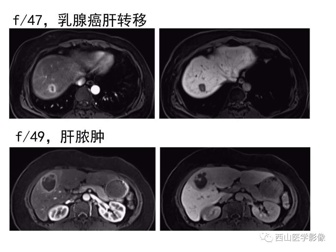 影像PPT - 【PPT】普美显临床应用病例解析-50