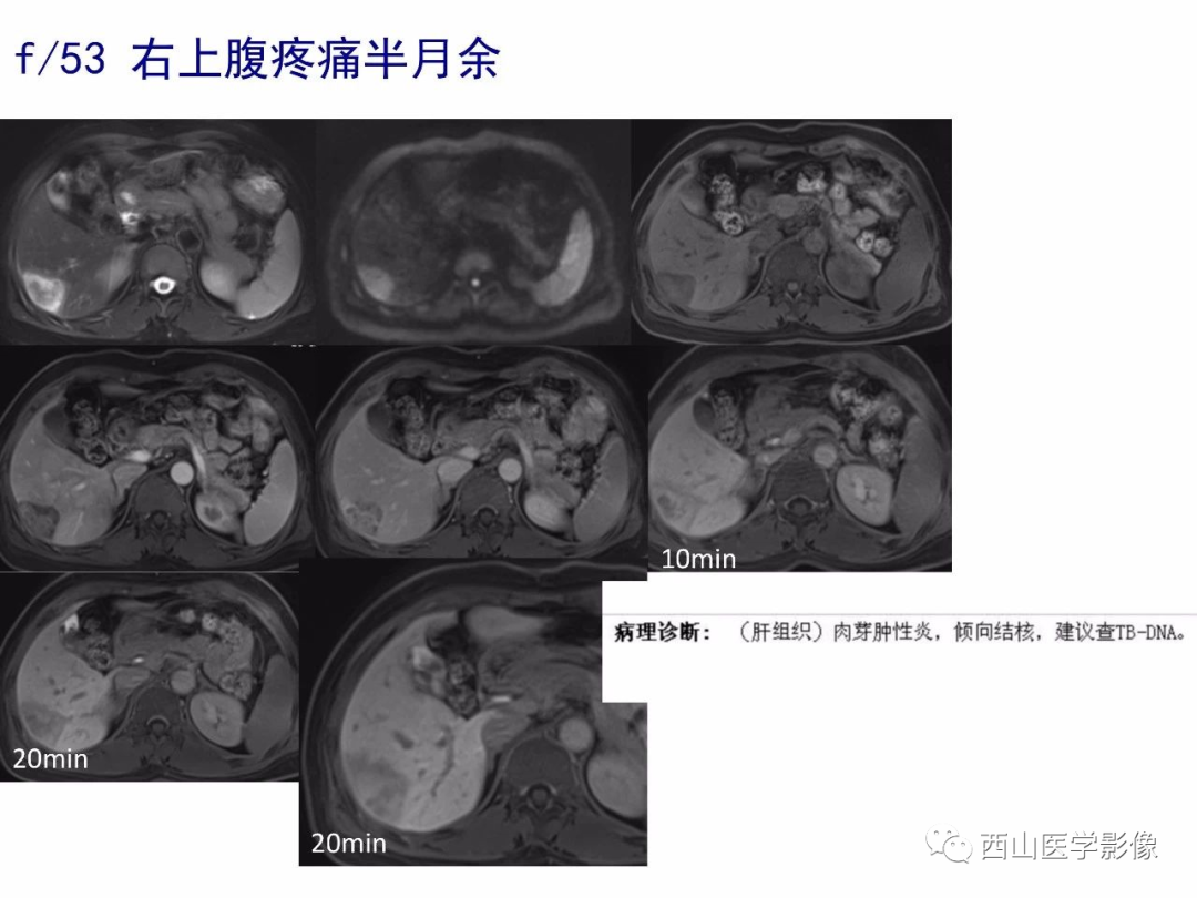 影像PPT - 【PPT】普美显临床应用病例解析-52