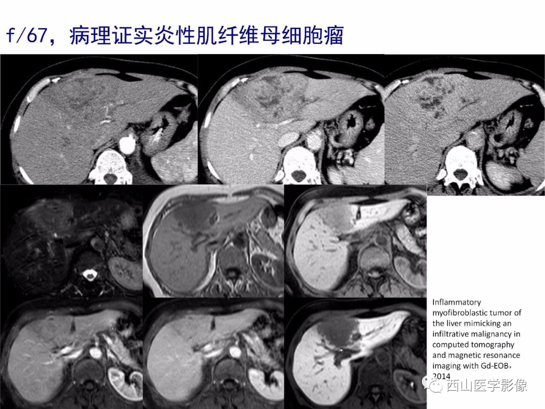影像PPT - 【PPT】普美显临床应用病例解析-55