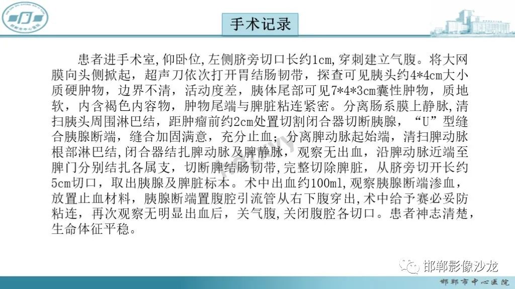 影像PPT - 【PPT】胰腺实性假乳头状瘤-10 影像PPT - 【PPT】胰腺实性假乳头状瘤-10