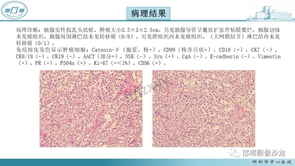 影像PPT - 【PPT】胰腺实性假乳头状瘤-11 影像PPT - 【PPT】胰腺实性假乳头状瘤-11