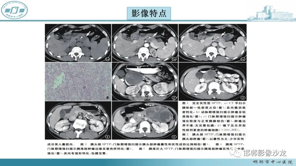 影像PPT - 【PPT】胰腺实性假乳头状瘤-18 影像PPT - 【PPT】胰腺实性假乳头状瘤-18
