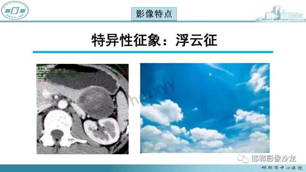影像PPT - 【PPT】胰腺实性假乳头状瘤-19 影像PPT - 【PPT】胰腺实性假乳头状瘤-19