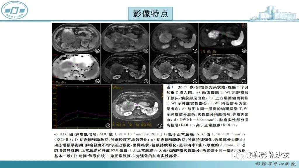 影像PPT - 【PPT】胰腺实性假乳头状瘤-21 影像PPT - 【PPT】胰腺实性假乳头状瘤-21