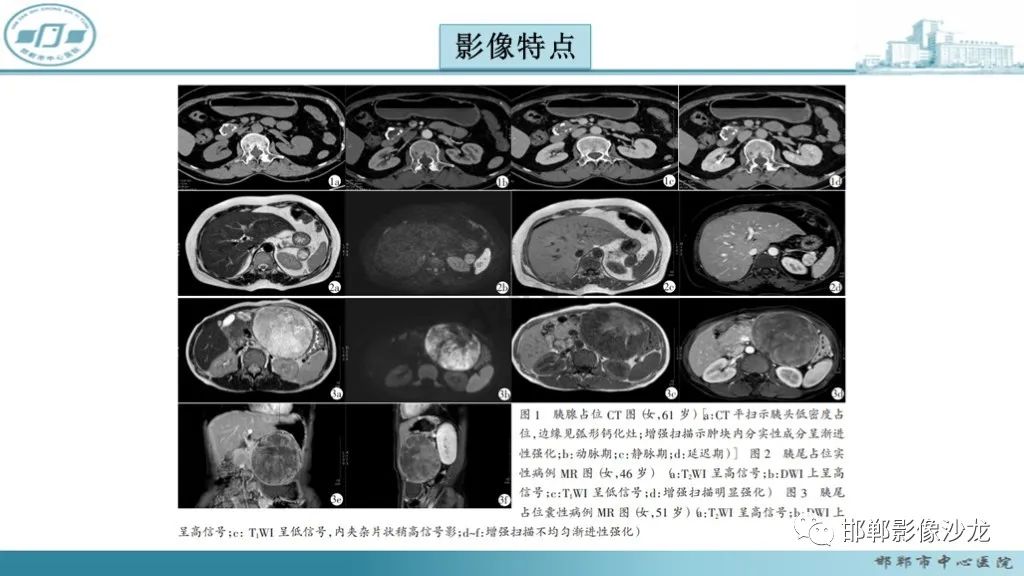 影像PPT - 【PPT】胰腺实性假乳头状瘤-22 影像PPT - 【PPT】胰腺实性假乳头状瘤-22