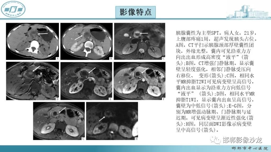 影像PPT - 【PPT】胰腺实性假乳头状瘤-23 影像PPT - 【PPT】胰腺实性假乳头状瘤-23