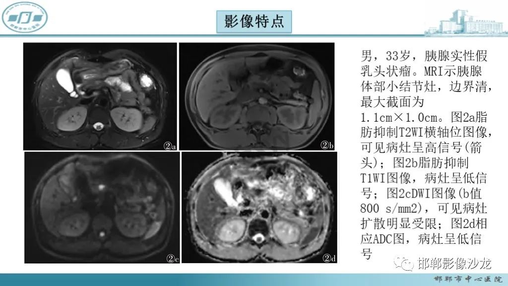 影像PPT - 【PPT】胰腺实性假乳头状瘤-25 影像PPT - 【PPT】胰腺实性假乳头状瘤-25