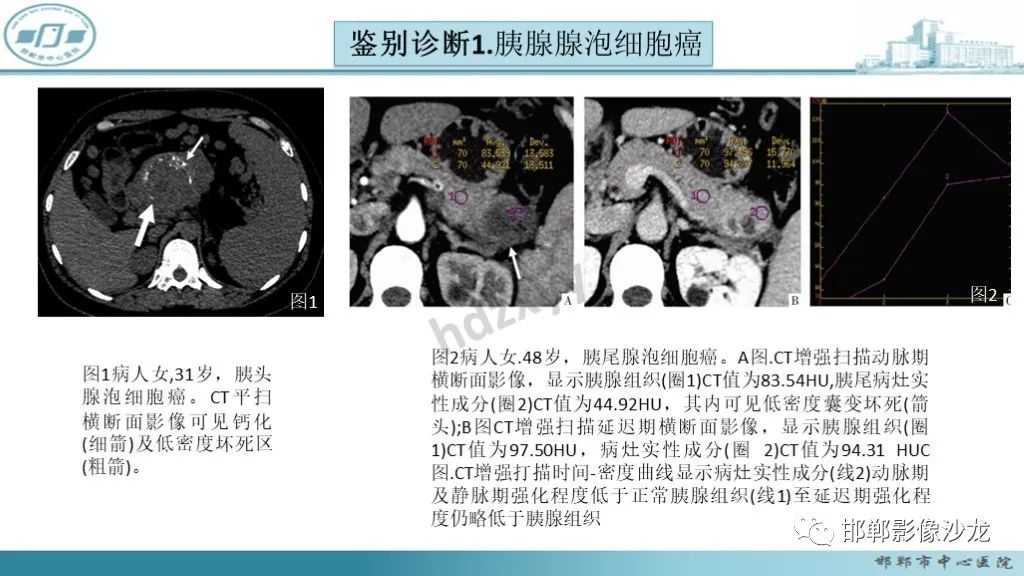 影像PPT - 【PPT】胰腺实性假乳头状瘤-30 影像PPT - 【PPT】胰腺实性假乳头状瘤-30