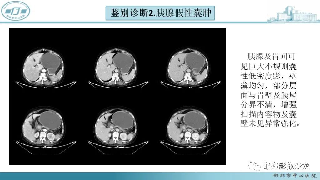 影像PPT - 【PPT】胰腺实性假乳头状瘤-33 影像PPT - 【PPT】胰腺实性假乳头状瘤-33