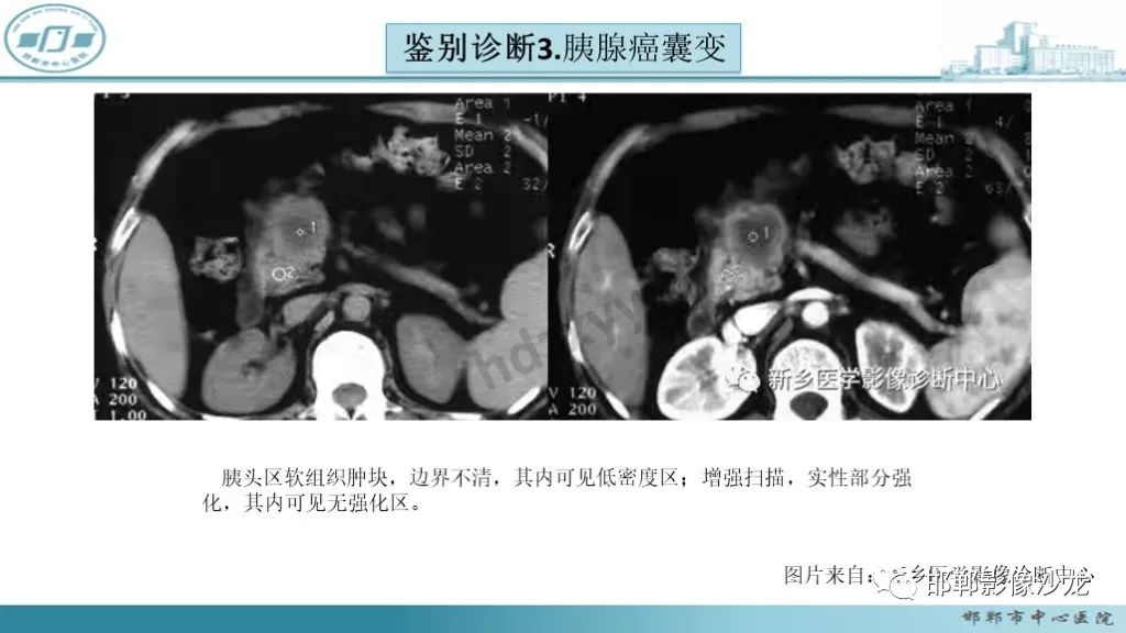 影像PPT - 【PPT】胰腺实性假乳头状瘤-35 影像PPT - 【PPT】胰腺实性假乳头状瘤-35