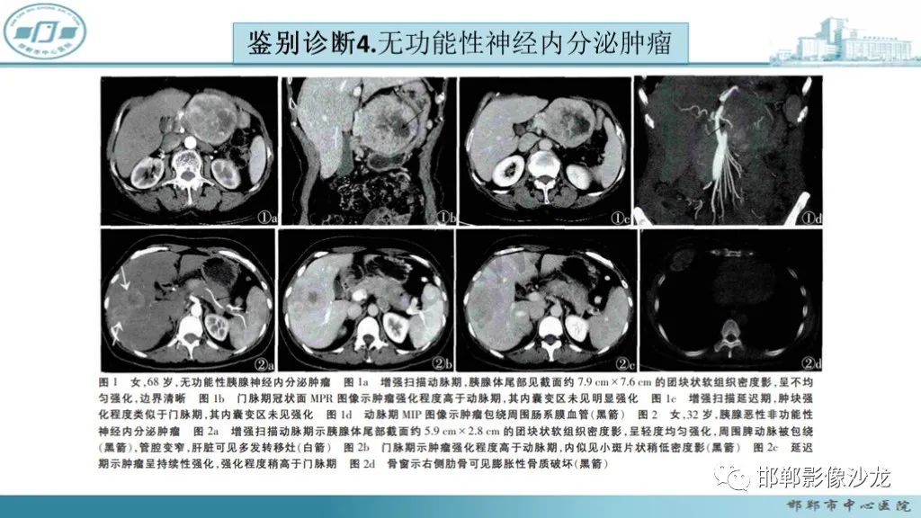 影像PPT - 【PPT】胰腺实性假乳头状瘤-39 影像PPT - 【PPT】胰腺实性假乳头状瘤-39