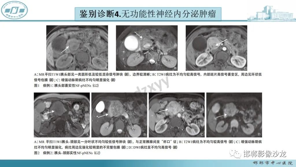 影像PPT - 【PPT】胰腺实性假乳头状瘤-40 影像PPT - 【PPT】胰腺实性假乳头状瘤-40
