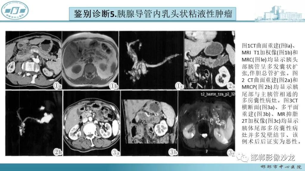 影像PPT - 【PPT】胰腺实性假乳头状瘤-43 影像PPT - 【PPT】胰腺实性假乳头状瘤-43