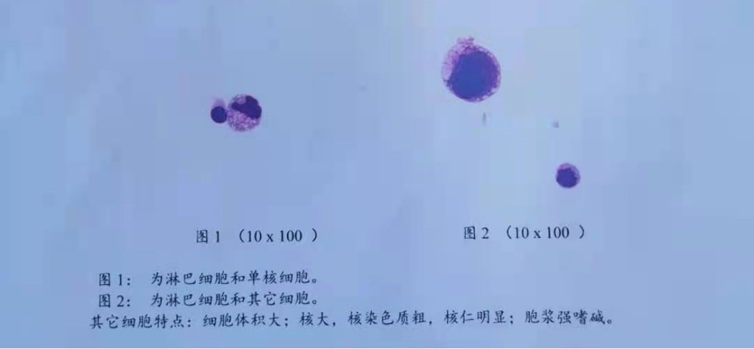 影像PPT - 脑MRI汉奸头”征—脑膜转移-7 影像PPT - 脑MRI汉奸头”征—脑膜转移-7
