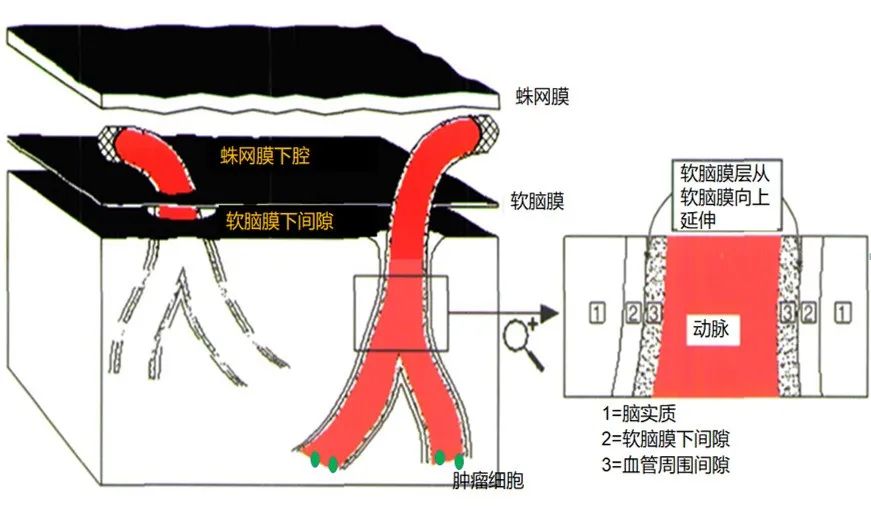 影像PPT - 脑MRI汉奸头”征—脑膜转移-8 影像PPT - 脑MRI汉奸头”征—脑膜转移-8