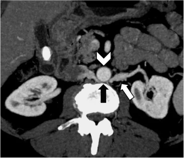 影像PPT - 7种腹部盆腔血管压迫综合征的CT表现-5