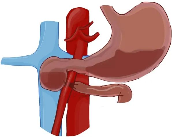 影像PPT - 7种腹部盆腔血管压迫综合征的CT表现-9