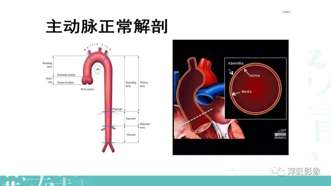 影像PPT - 【PPT】急性主动脉综合征之主动脉夹层“三兄弟”-3