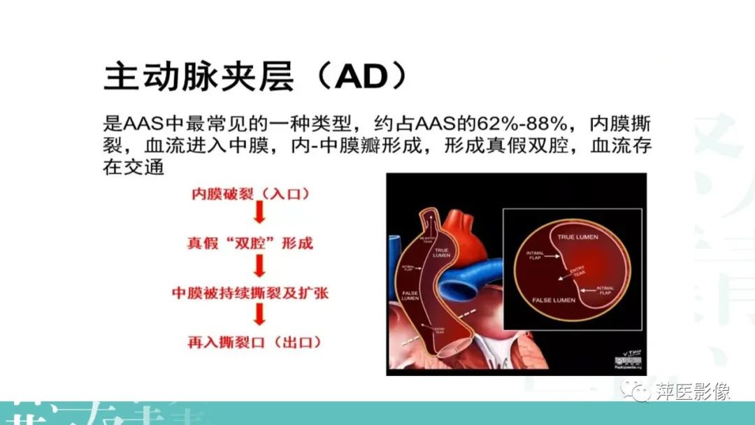 影像PPT - 【PPT】急性主动脉综合征之主动脉夹层“三兄弟”-5