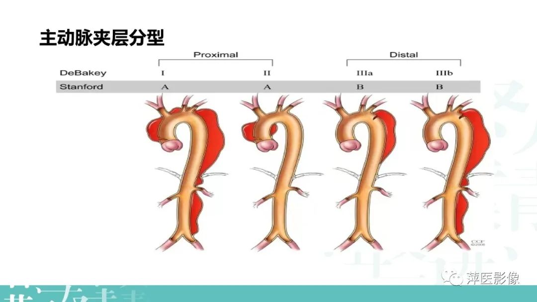 影像PPT - 【PPT】急性主动脉综合征之主动脉夹层“三兄弟”-6