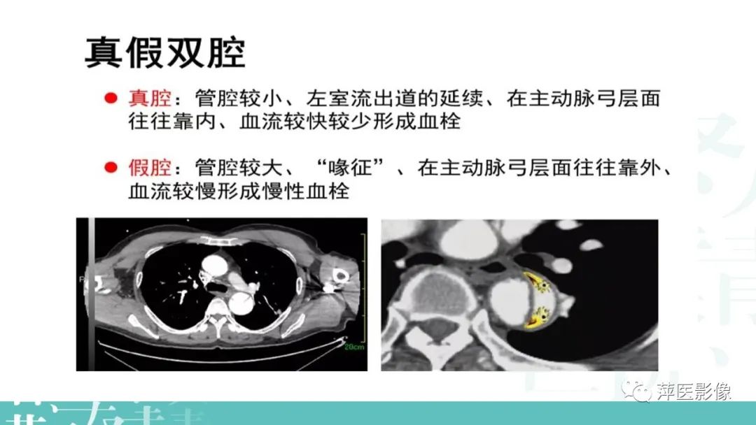 影像PPT - 【PPT】急性主动脉综合征之主动脉夹层“三兄弟”-10