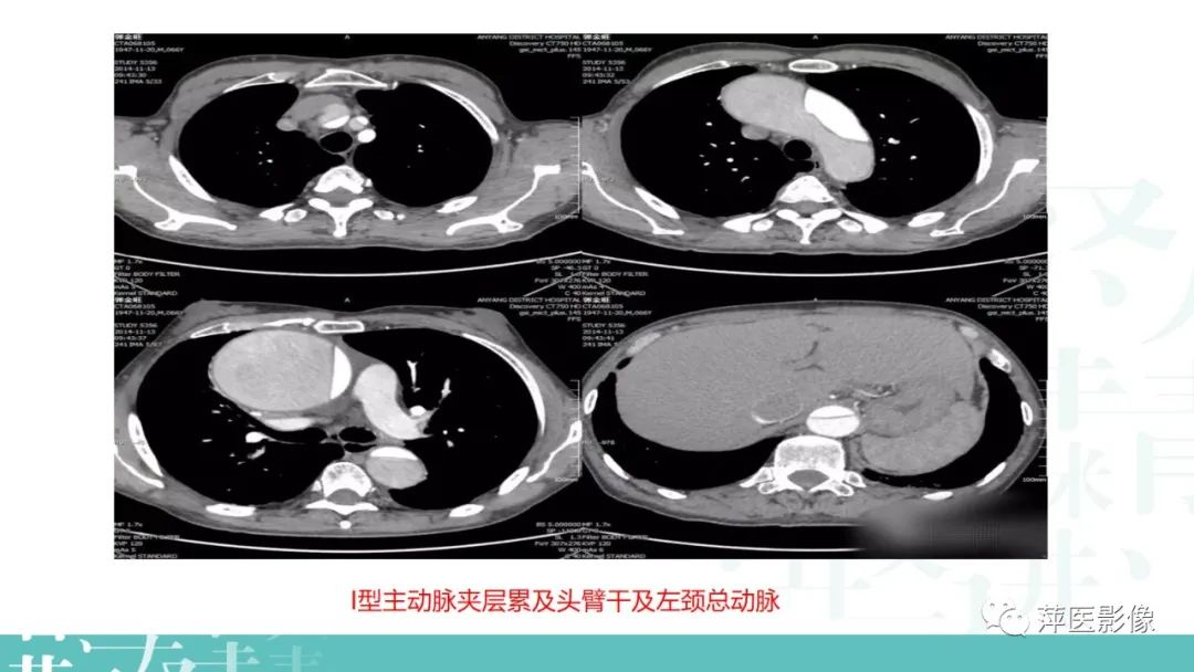 影像PPT - 【PPT】急性主动脉综合征之主动脉夹层“三兄弟”-11
