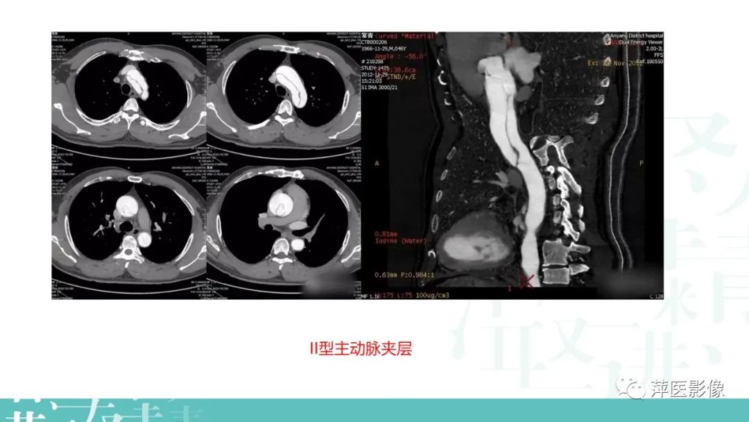 影像PPT - 【PPT】急性主动脉综合征之主动脉夹层“三兄弟”-12