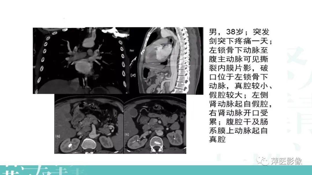 影像PPT - 【PPT】急性主动脉综合征之主动脉夹层“三兄弟”-13