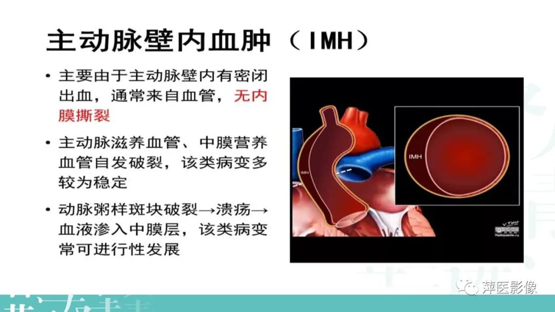 影像PPT - 【PPT】急性主动脉综合征之主动脉夹层“三兄弟”-15