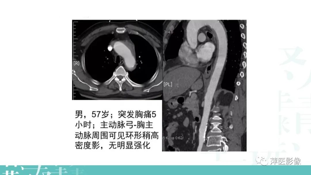 影像PPT - 【PPT】急性主动脉综合征之主动脉夹层“三兄弟”-17