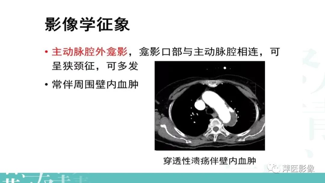 影像PPT - 【PPT】急性主动脉综合征之主动脉夹层“三兄弟”-19