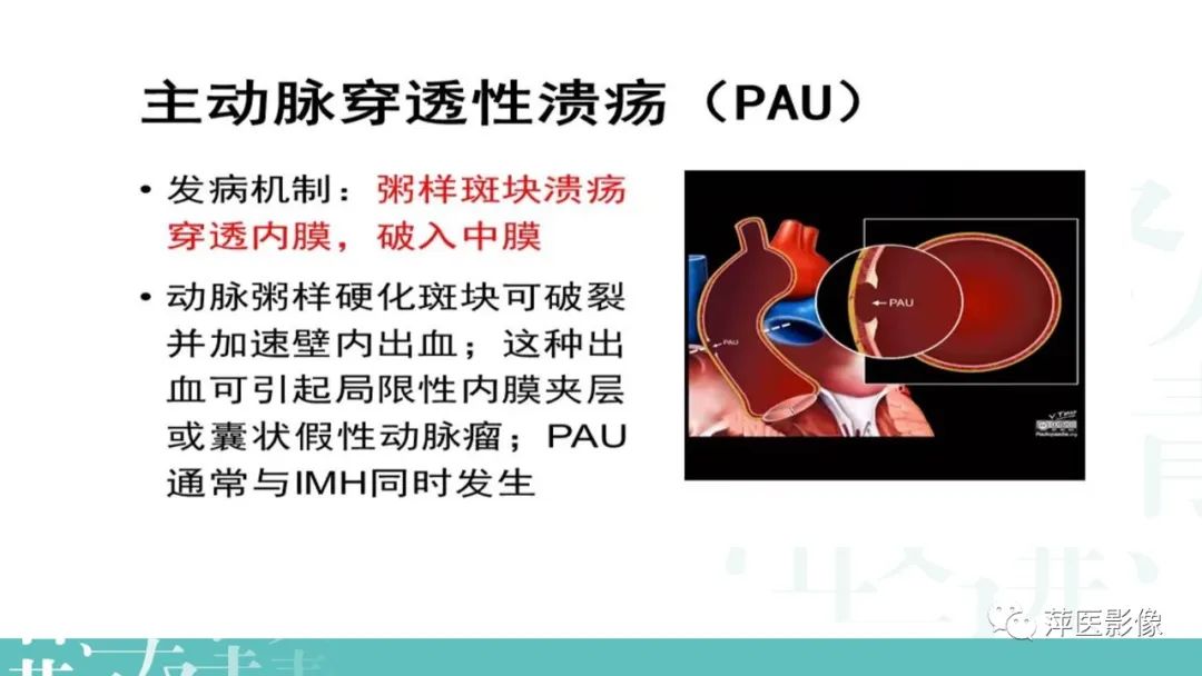 影像PPT - 【PPT】急性主动脉综合征之主动脉夹层“三兄弟”-18
