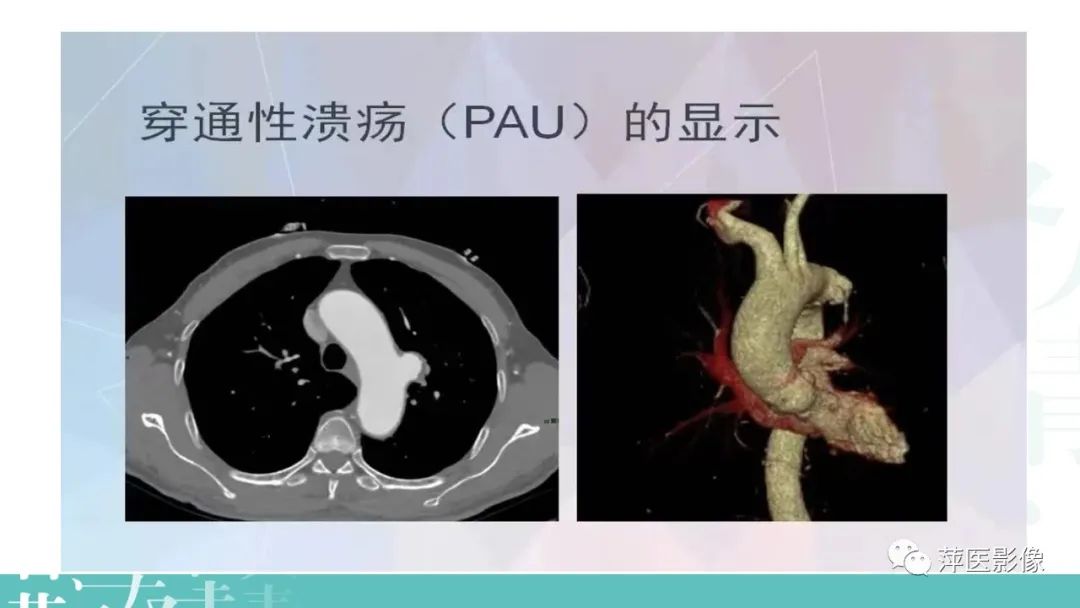 影像PPT - 【PPT】急性主动脉综合征之主动脉夹层“三兄弟”-20
