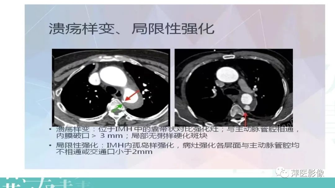 影像PPT - 【PPT】急性主动脉综合征之主动脉夹层“三兄弟”-21