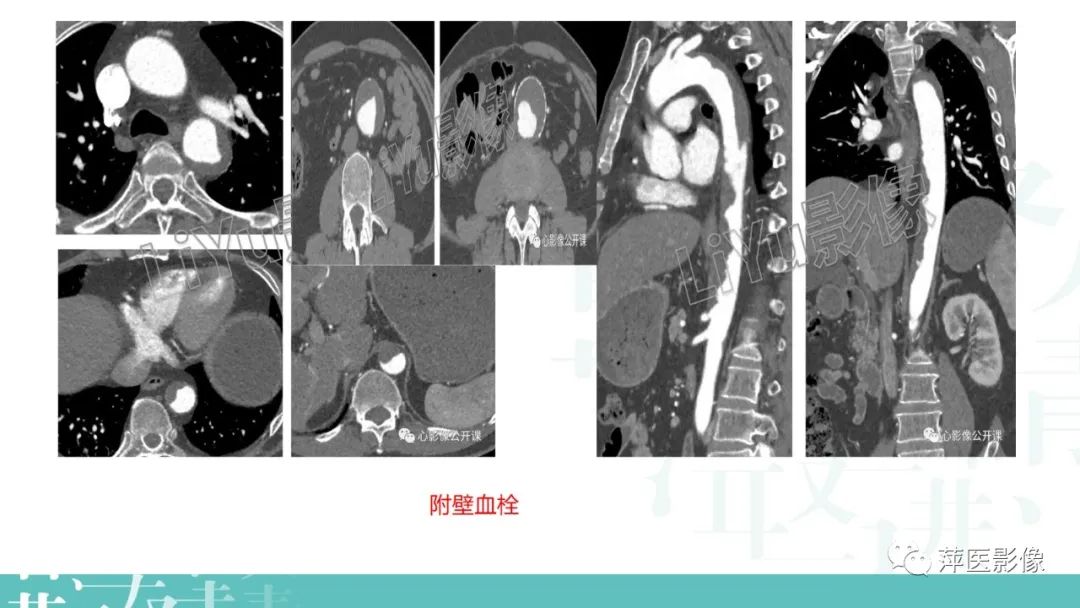影像PPT - 【PPT】急性主动脉综合征之主动脉夹层“三兄弟”-25