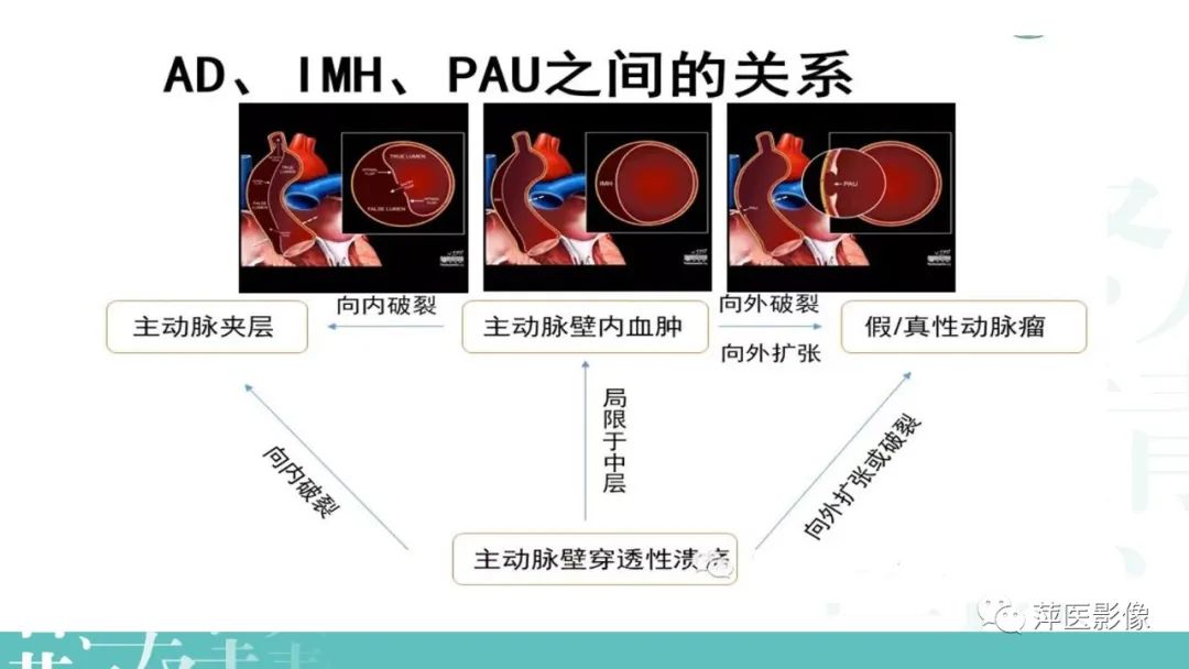 影像PPT - 【PPT】急性主动脉综合征之主动脉夹层“三兄弟”-23