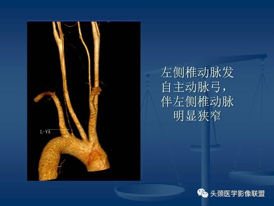 影像PPT - 【PPT】头颈部CTA和DSA对血管病变的诊断-9