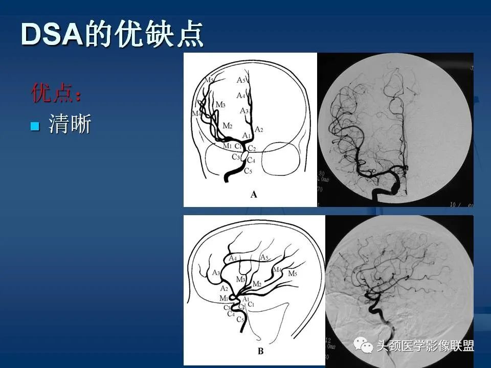 影像PPT - 【PPT】头颈部CTA和DSA对血管病变的诊断-13