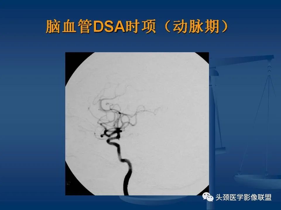 影像PPT - 【PPT】头颈部CTA和DSA对血管病变的诊断-15