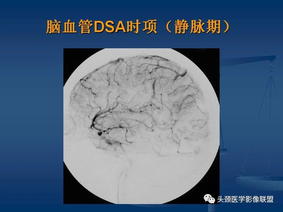 影像PPT - 【PPT】头颈部CTA和DSA对血管病变的诊断-17