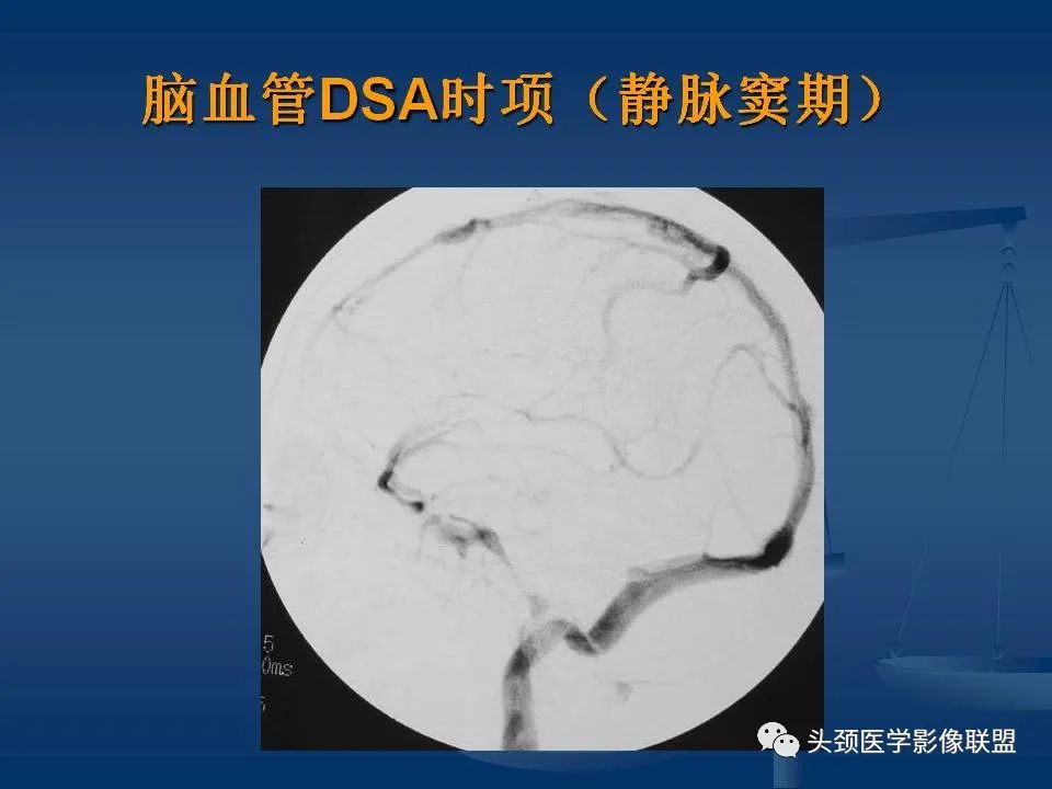 影像PPT - 【PPT】头颈部CTA和DSA对血管病变的诊断-18