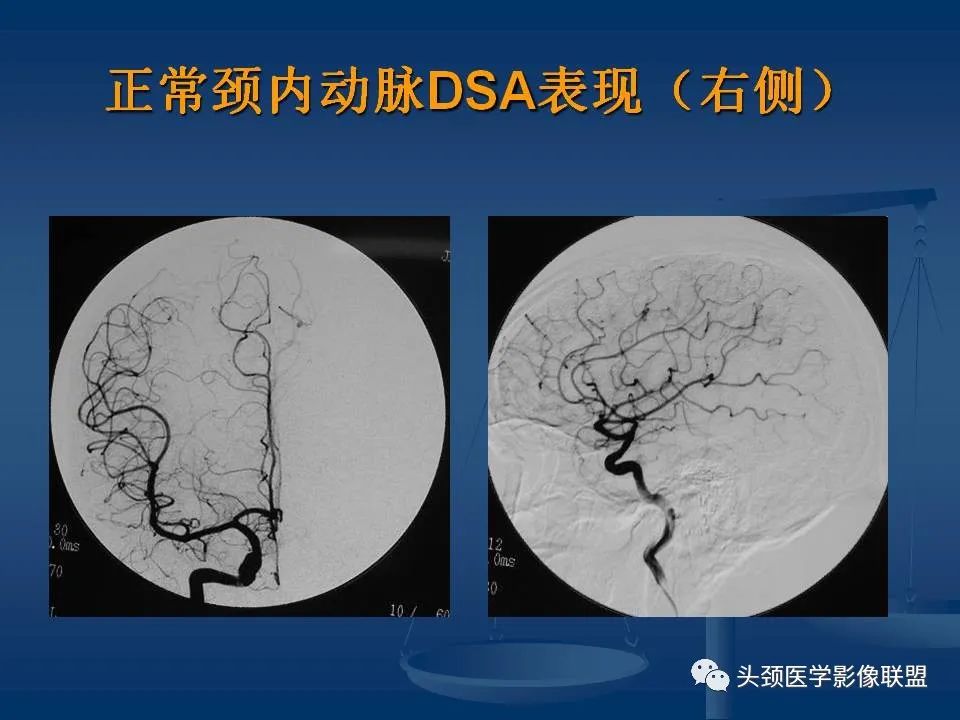 影像PPT - 【PPT】头颈部CTA和DSA对血管病变的诊断-26
