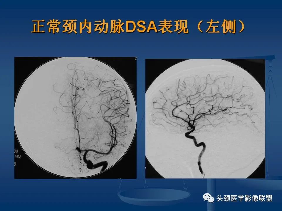 影像PPT - 【PPT】头颈部CTA和DSA对血管病变的诊断-27