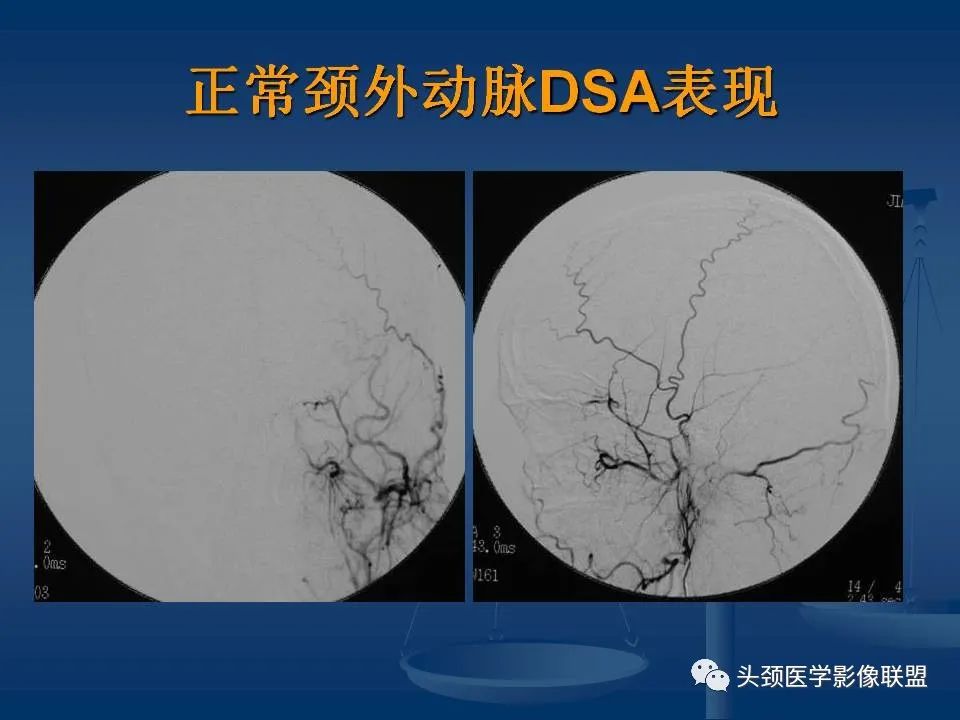 影像PPT - 【PPT】头颈部CTA和DSA对血管病变的诊断-28