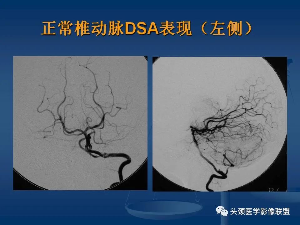 影像PPT - 【PPT】头颈部CTA和DSA对血管病变的诊断-29