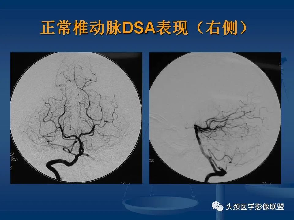 影像PPT - 【PPT】头颈部CTA和DSA对血管病变的诊断-30