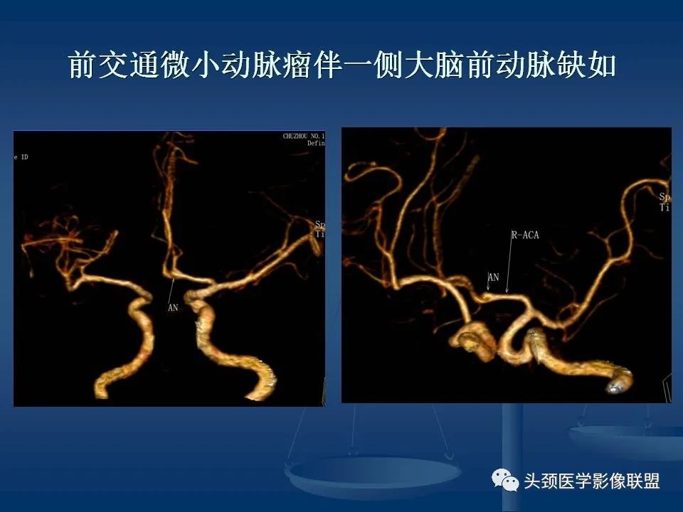 影像PPT - 【PPT】头颈部CTA和DSA对血管病变的诊断-37
