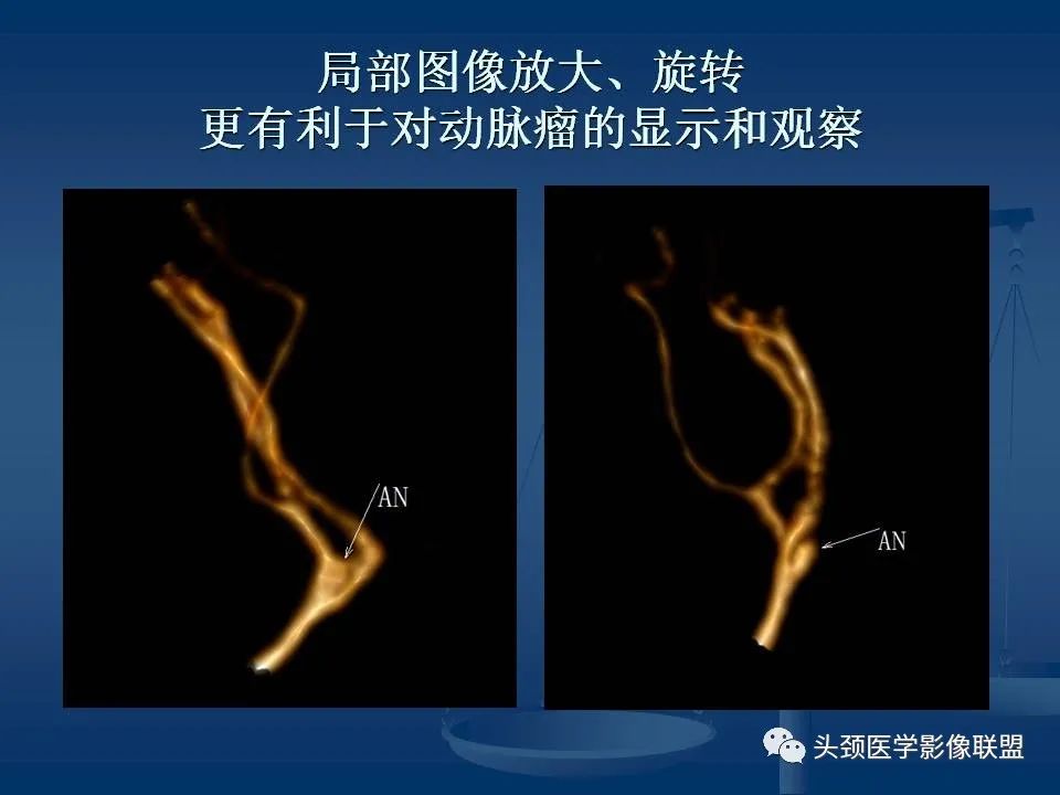 影像PPT - 【PPT】头颈部CTA和DSA对血管病变的诊断-38