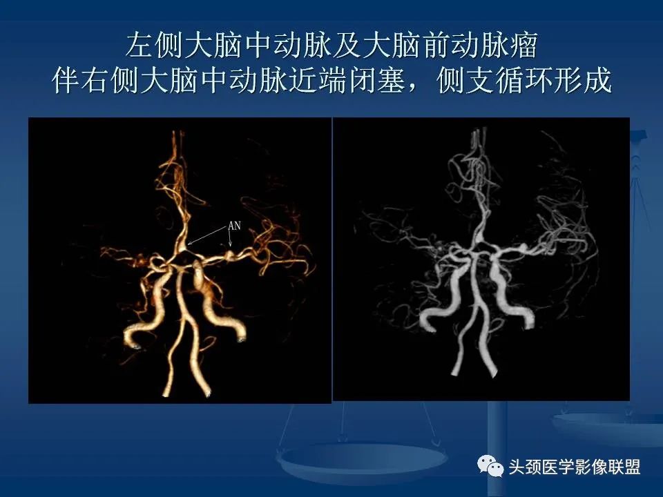 影像PPT - 【PPT】头颈部CTA和DSA对血管病变的诊断-40