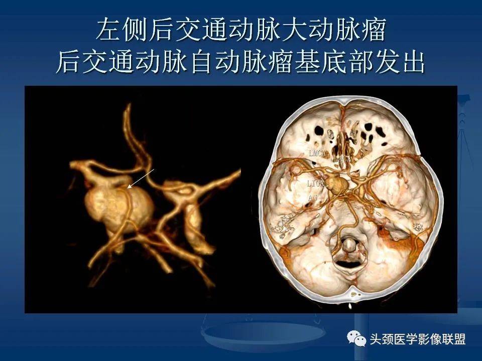 影像PPT - 【PPT】头颈部CTA和DSA对血管病变的诊断-42